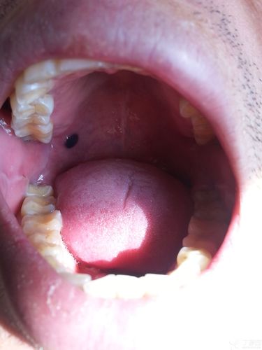 牙龈上有血泡怎麼辦（舌下長血泡怎麼回事）1