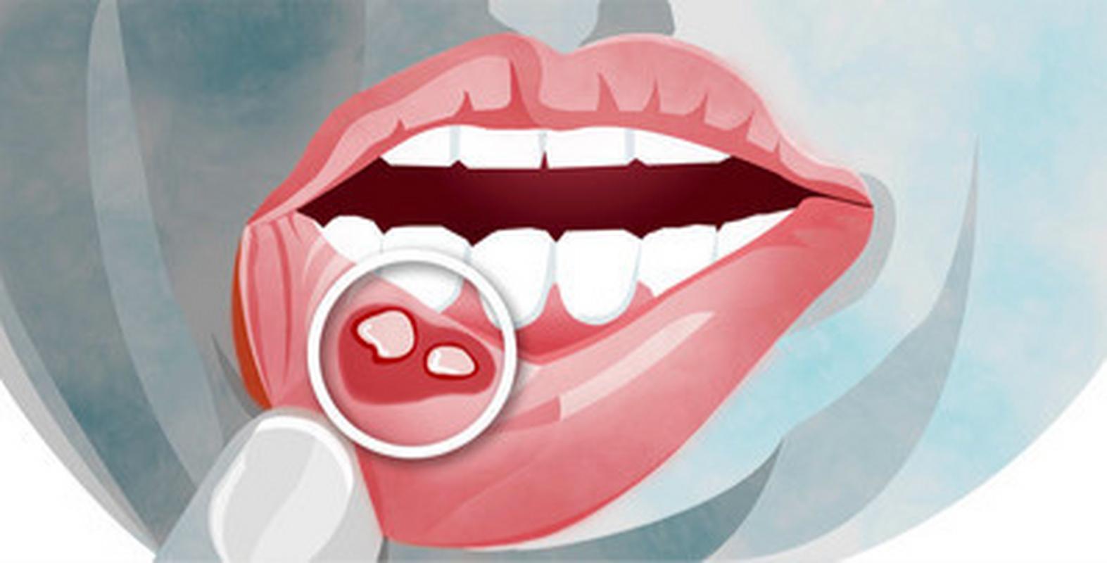 口腔潰瘍頻繁發作是什麼病的前兆（口腔潰瘍老發作）1