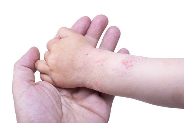 小孩皮膚瘙癢最簡單自愈方法（長期堅持科學方法）1