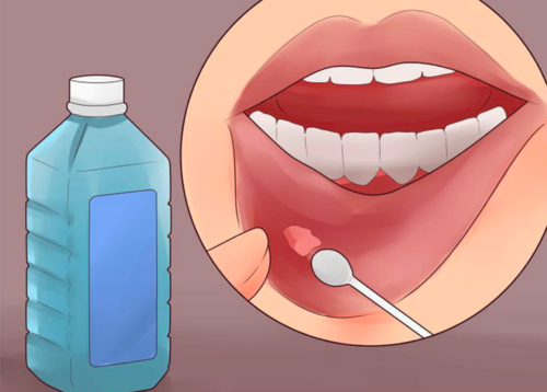 嘴潰瘍最快治療方法