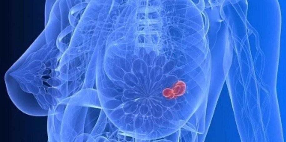 乳房摸到硬塊就是腫瘤嗎（乳房摸到包塊沒在意）1