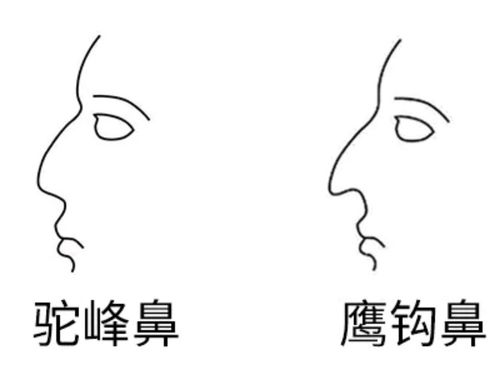 駝峰鼻跟鷹鈎鼻的區别是什麼（駝峰鼻跟鷹鈎鼻的區别是啥）1