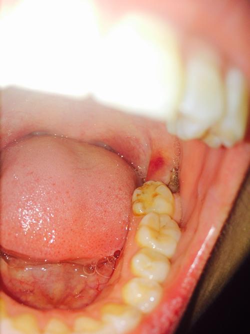 拔牙後牙疼多久能消除（拔牙後鄰牙疼多久恢複正常）1