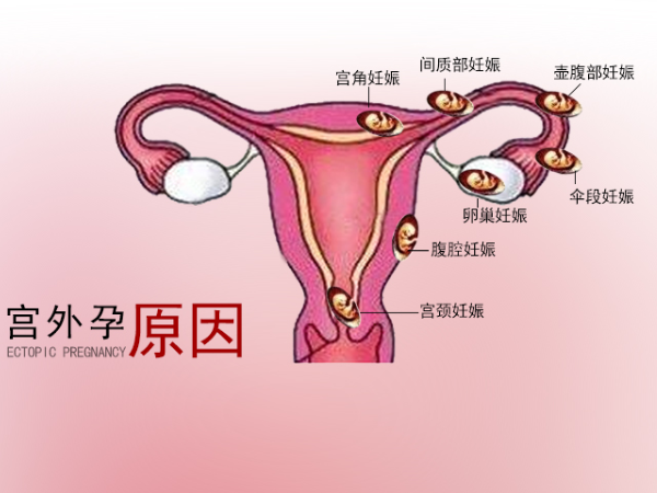 什麼是宮外孕是由什麼原因引起的（什麼是宮外孕）1