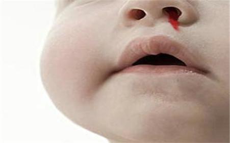幼兒鼻出血常見原因是什麼