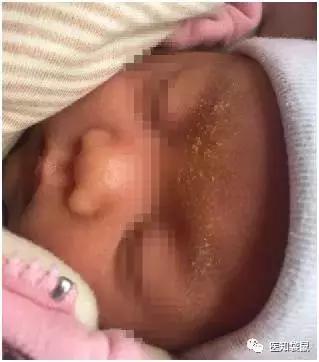 剛出生的寶寶哪種皮膚病最易得（寶寶這幾種常見皮膚病看着很吓人）4