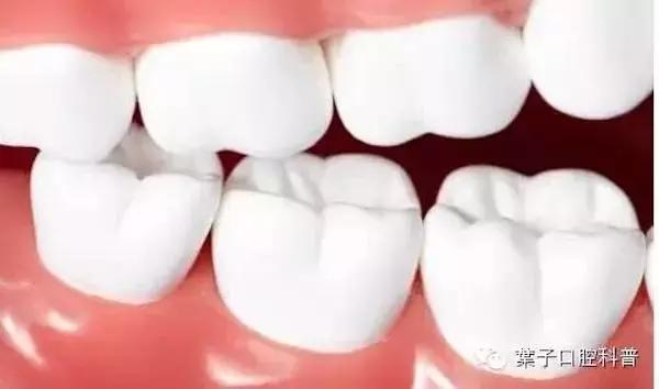 牙齒正畸可以隻矯正上面的牙齒嗎（隻是上排牙齒不齊）4