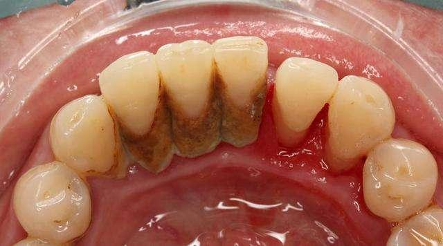 牙齒上長滿了牙結石怎麼弄掉（下颚的牙齒裡面有很多牙結石）1