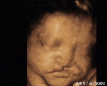 八個月發現胎兒畸形怎麼辦（懷孕八個月查出畸形）2