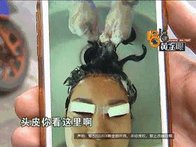 女子割雙眼皮後化膿（頭發被膠水粘住）5