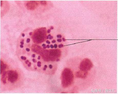 孕期感染B族鍊球菌怎麼辦