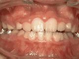 嘴凸矯正牙齒的全過程（是魔法還是藝術）3