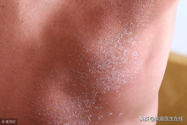 皮膚起癬一般是什麼原因引起（冬季皮膚出現這幾個症狀）1