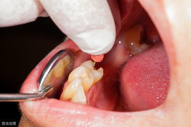 牙齒根管治療了一年後又痛（根管治療的四個步驟）2
