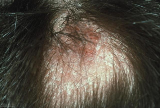 頭皮屑是頭癬嗎怎麼治療（頭癬是頭屑多嗎）1