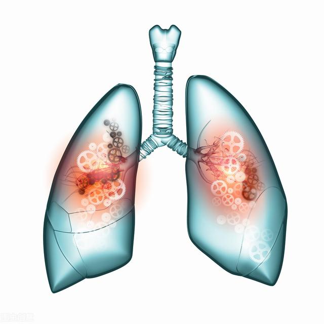 肺癌晚期骨轉移有什麼治療方案（肺癌骨轉移有什麼表現）2