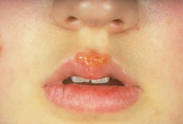 小孩喉嚨口有疱疹怎麼辦