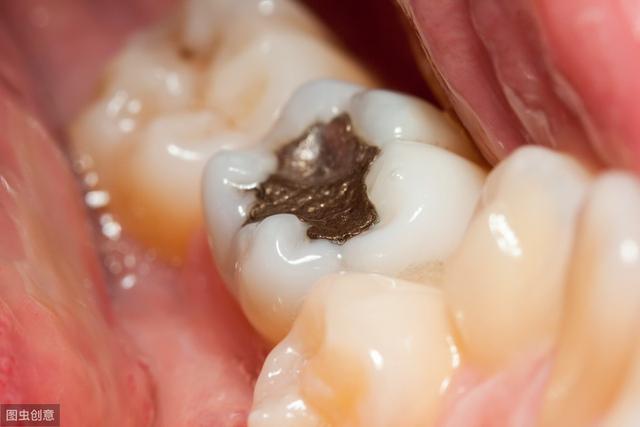 牙齒根尖化膿還能保留嗎（牙齒表面出現小黑點）6