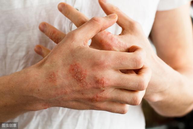 幹性濕疹和滲透性濕疹有什麼區别（濕疹怎麼區分幹性和濕性）2