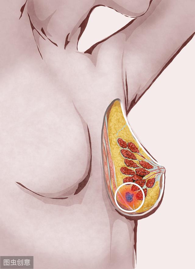 乳腺增生與乳腺癌超聲報告的區别（從乳腺篩查開始）6
