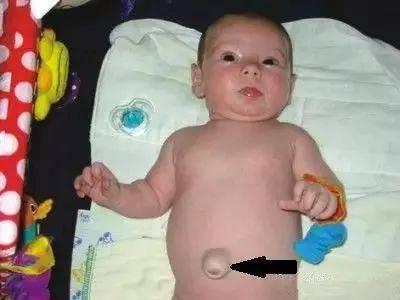 寶寶右側腹部有個包塊是疝氣嗎