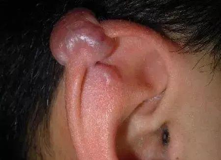 耳洞打了有兩個月了有一個硬疙瘩（這種人别随便打耳洞）16