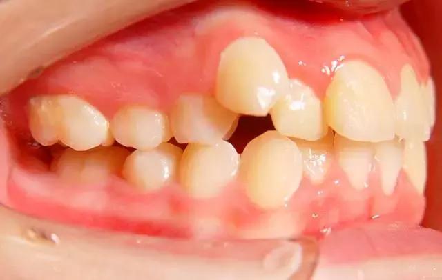 遺傳性牙颌畸形的主要表現方式（孩子的這20種牙颌畸形問題需要在12歲前解決）5