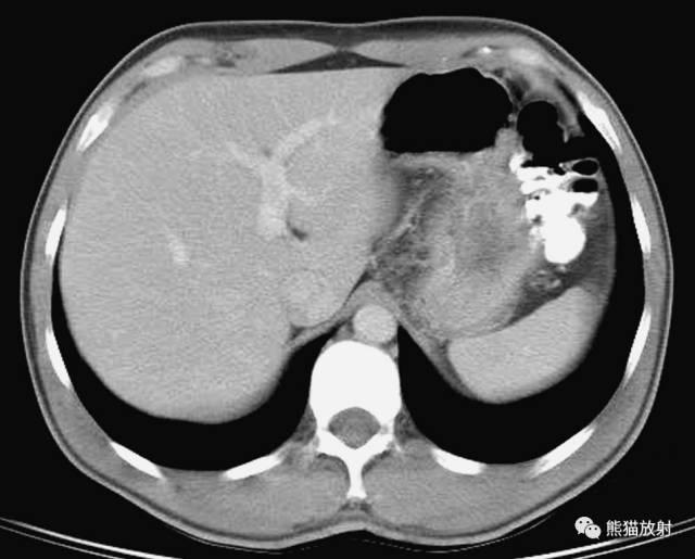 肝總管ct解剖位置（收藏上腹部CT斷層）10