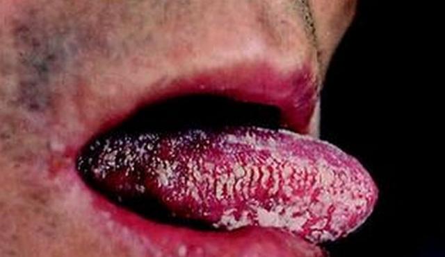 艾滋病引起口腔疾病的症狀（口腔出現這4種病變）2