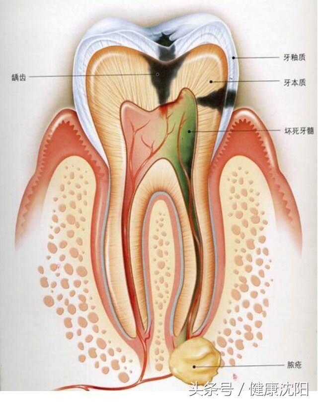 可逆牙髓炎與不可逆牙髓炎的區别（牙髓炎的治療和預防）2