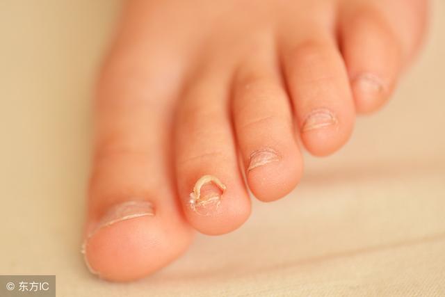灰指甲是什麼原因造成的傳染嗎（灰指甲有6大症狀）2