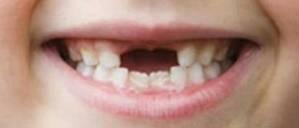 牙颌畸形的基本分類（這20種牙颌畸形問題需要在12歲前解決）9
