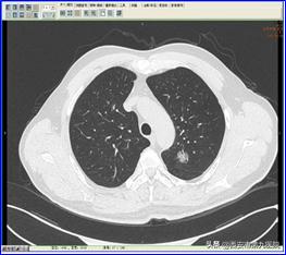 肺癌左肺雙肺小結節（肺小結節肺癌）4