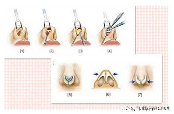 鼻部整形綜合手術有哪些（鼻部整形手術有哪些）2