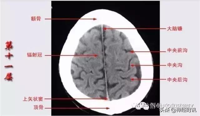 正确認識顱腦ct解剖圖譜（解剖影像）13