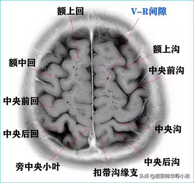 聽影像大咖講顱腦ct解剖（顱腦磁共振MRI解剖結構以及高清圖譜）3