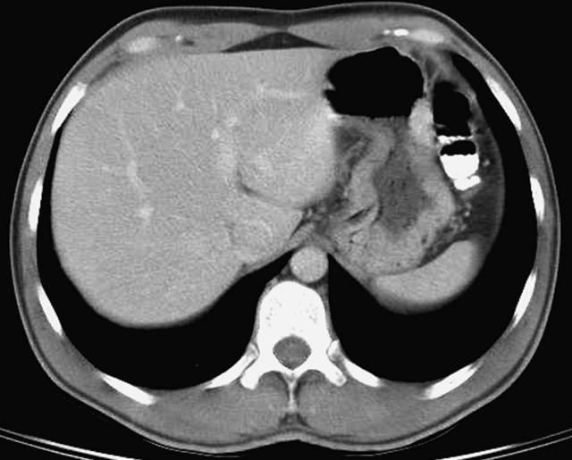 肝總管ct解剖位置（收藏上腹部CT斷層）6