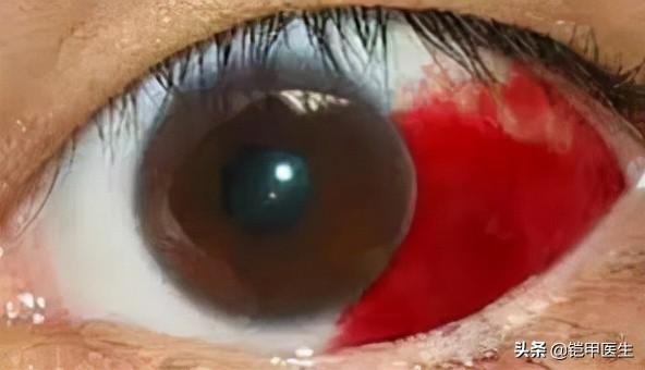眼睛為什麼會出血什麼原因（眼睛出血是怎麼回事）1