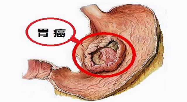 癌症出現在腹部的表現（體内有癌腹部先知）13
