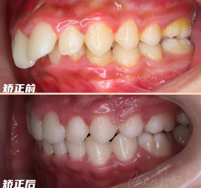 重慶種牙好還是鑲牙好（深覆合不僅影響你的口腔健康）3