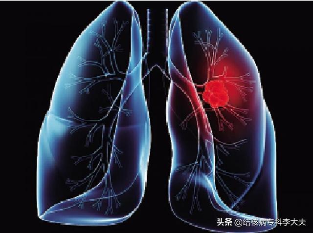 肺部空洞需要長期治療嗎（肺上有空洞還能治好嗎）3