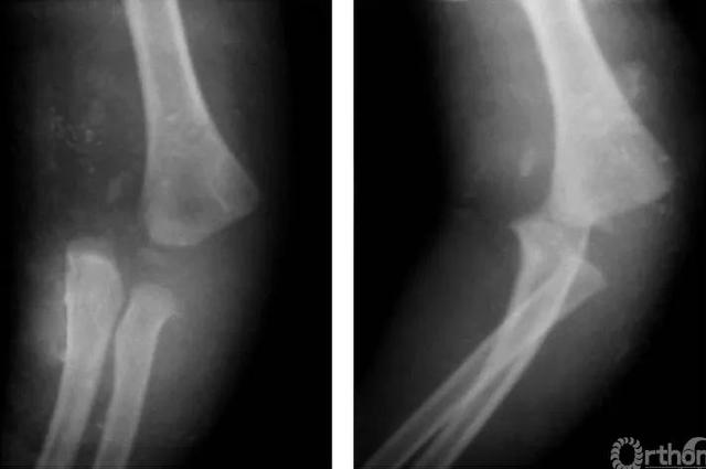 肱骨遠端全骺分離的治療方法（骨科常見疾病X線解析之肱骨遠端全骨骺分離）2