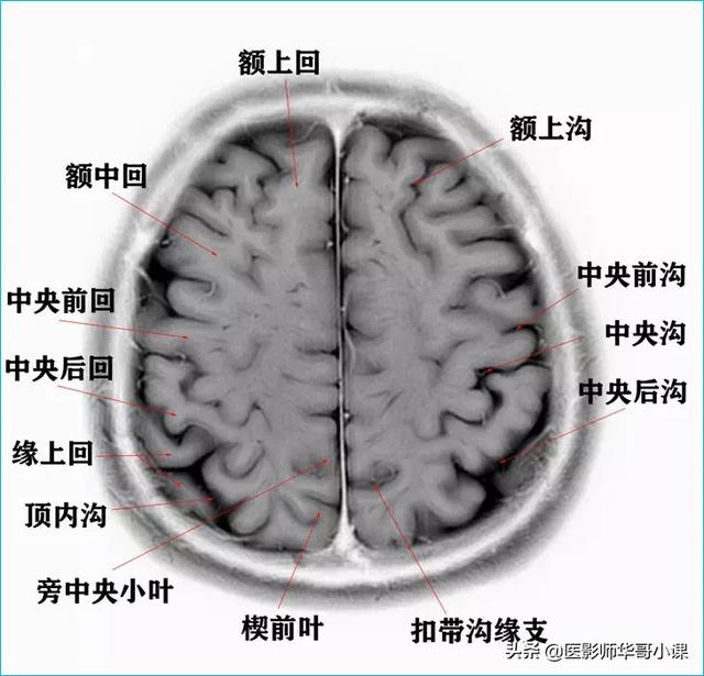 聽影像大咖講顱腦ct解剖（顱腦磁共振MRI解剖結構以及高清圖譜）5