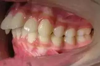 遺傳性牙颌畸形的主要表現方式（孩子的這20種牙颌畸形問題需要在12歲前解決）4