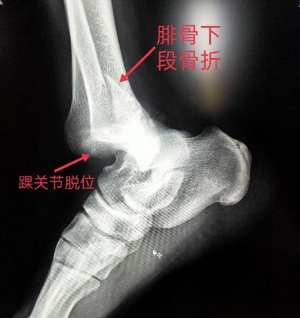 踝關節跟骨畸形x線描述（學習X線讀片指南骨）6