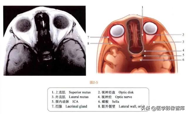 ct與mri斷層解剖學袖珍圖譜電子版（眼眶MRI斷層解剖速查圖譜）6