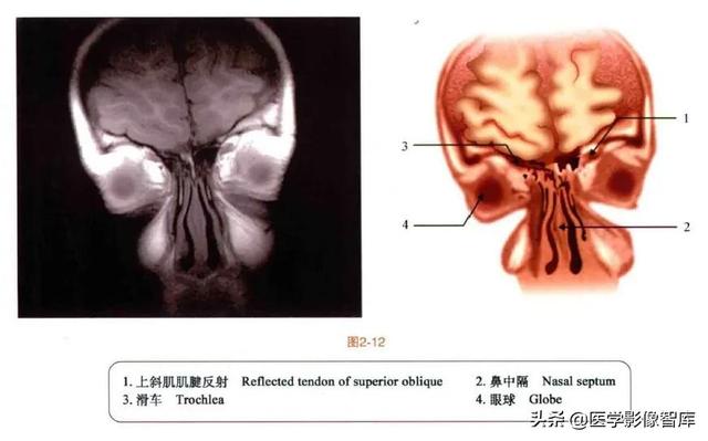 ct與mri斷層解剖學袖珍圖譜電子版（眼眶MRI斷層解剖速查圖譜）13