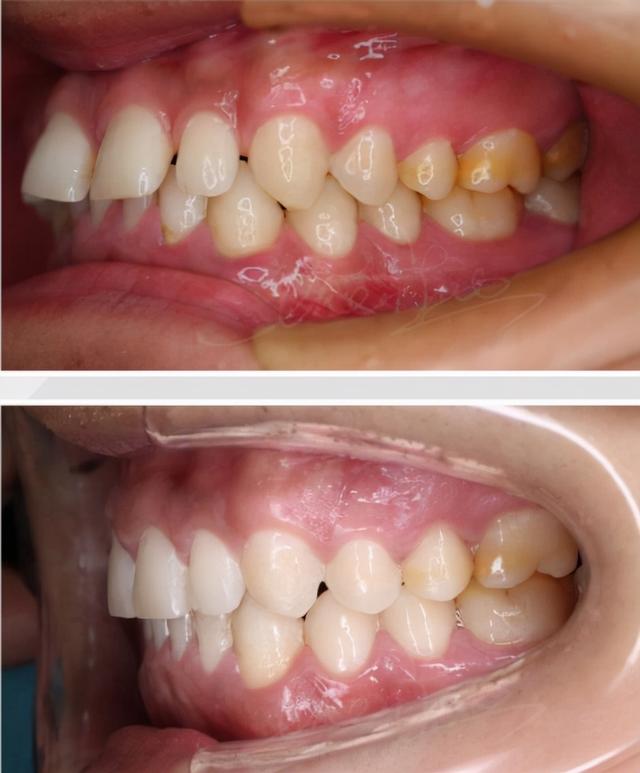 重慶種牙好還是鑲牙好（深覆合不僅影響你的口腔健康）10