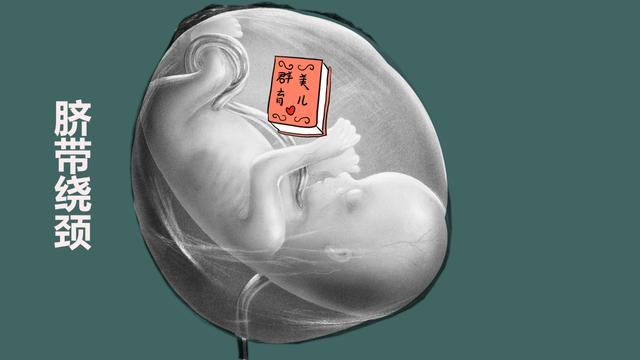 胎兒臍帶繞頸缺氧可以救嗎（臍帶纏頸導緻胎兒缺氧）1