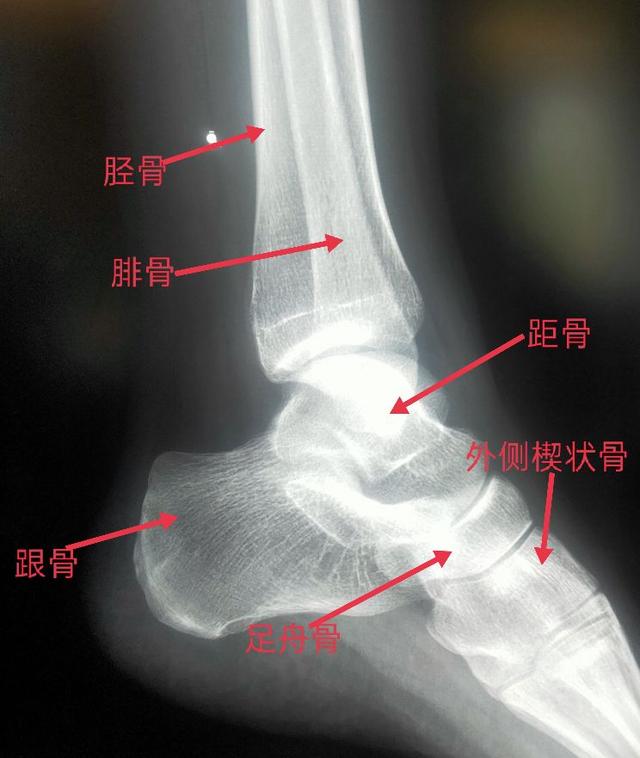 踝關節跟骨畸形x線描述（學習X線讀片指南骨）5